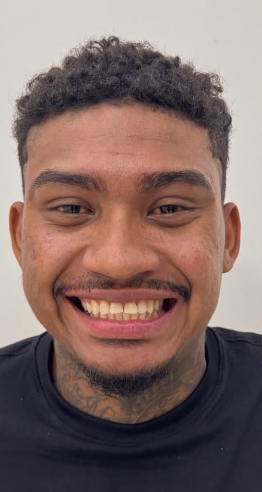 Reabilitação do sorriso — antes do tratamento