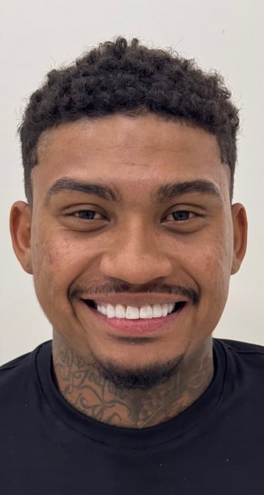 Reabilitação do sorriso — depois do tratamento