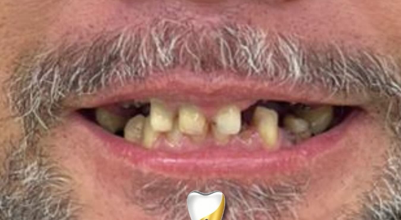 Reabilitação do sorriso superior — antes do tratamento