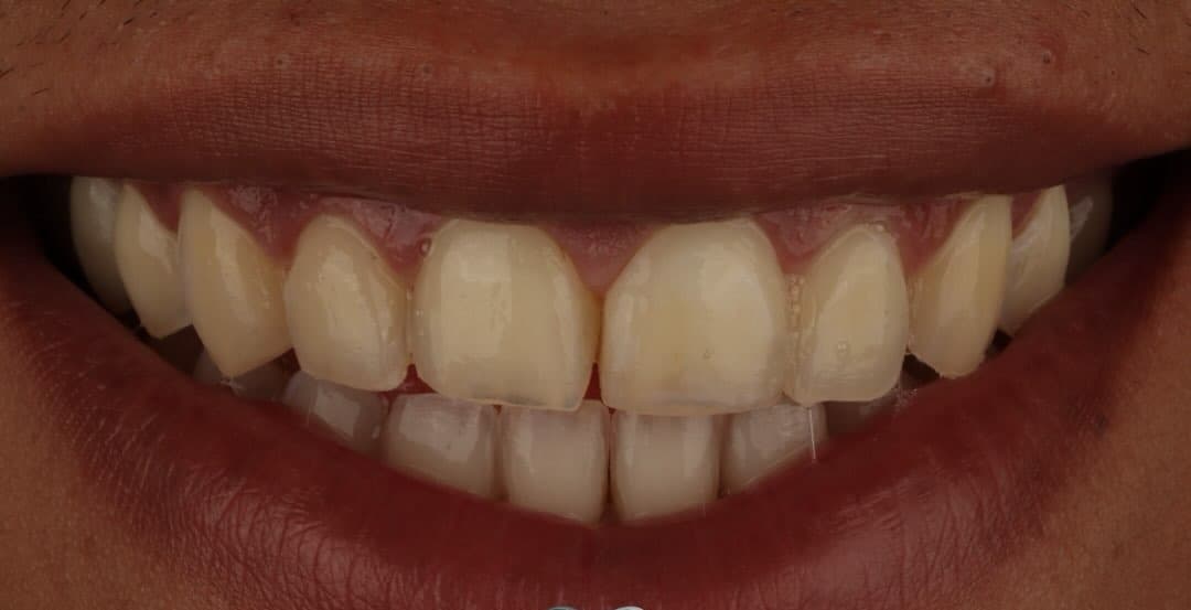 Estética dental — antes do tratamento