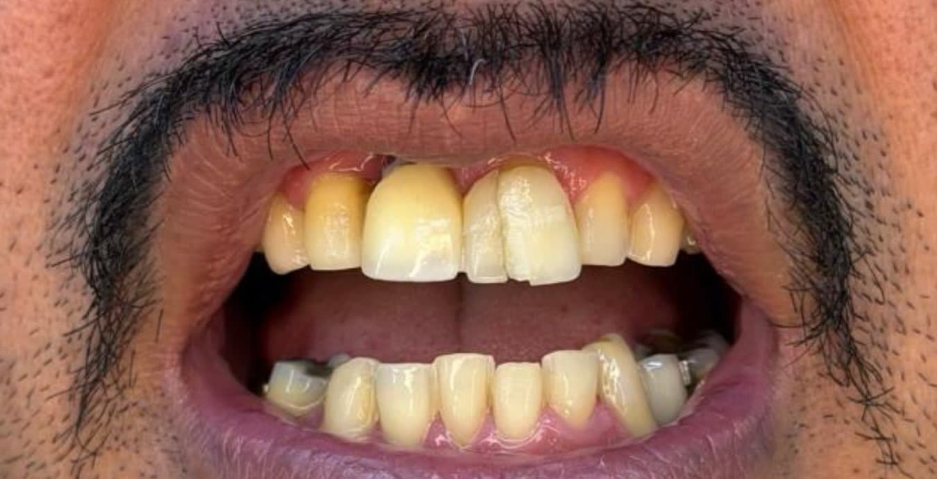 Estética dental — antes do tratamento