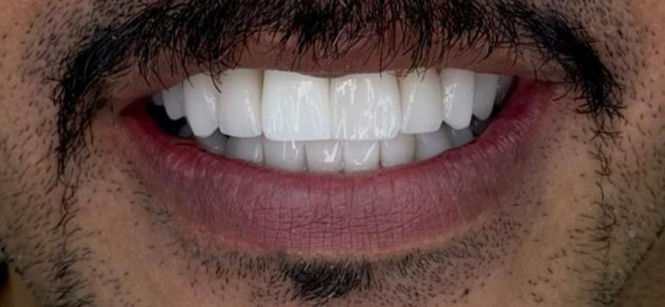 Prótese dentária