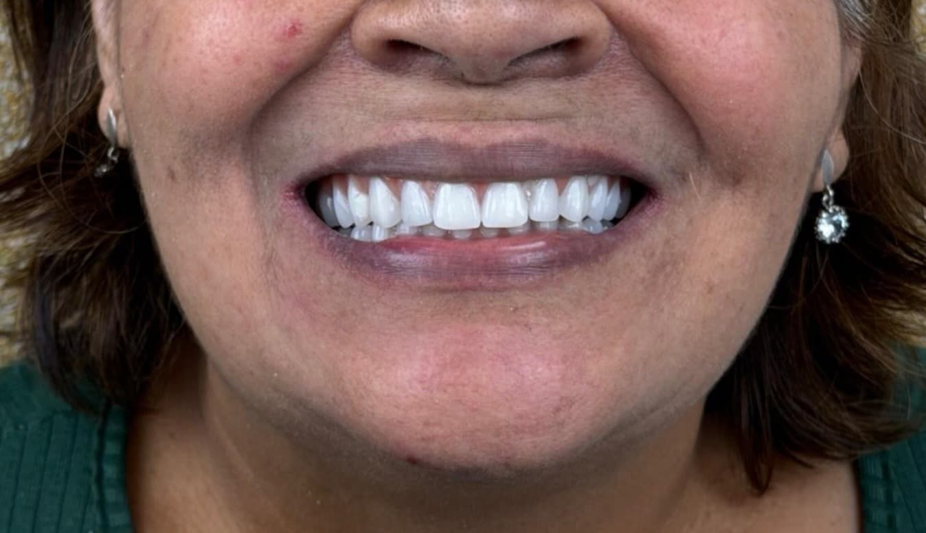 Implantes dentários
