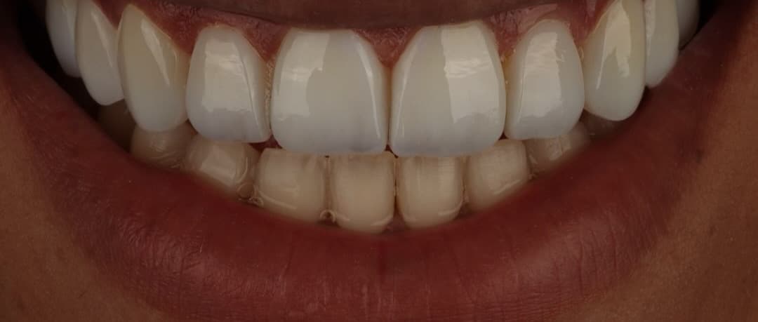Detalhe de sorriso tratado na Odonto Elity